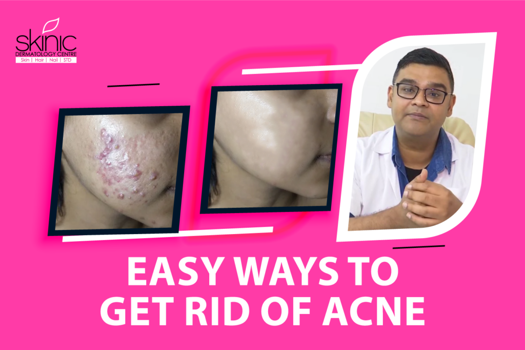 Acne Treatment