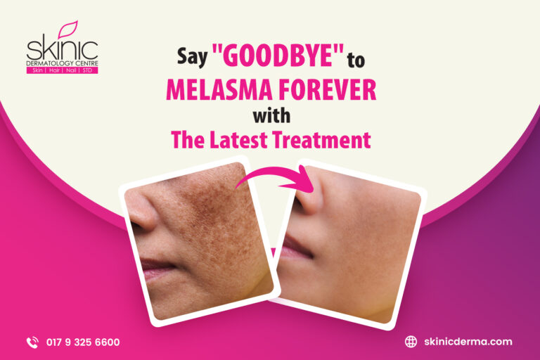 Melasma Treatment in Bangladesh - Skinic Dermatology Center
