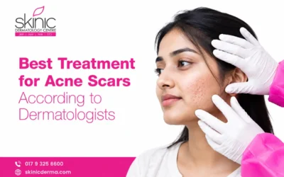 Best Treatment for Acne Scars According to Dermatologists