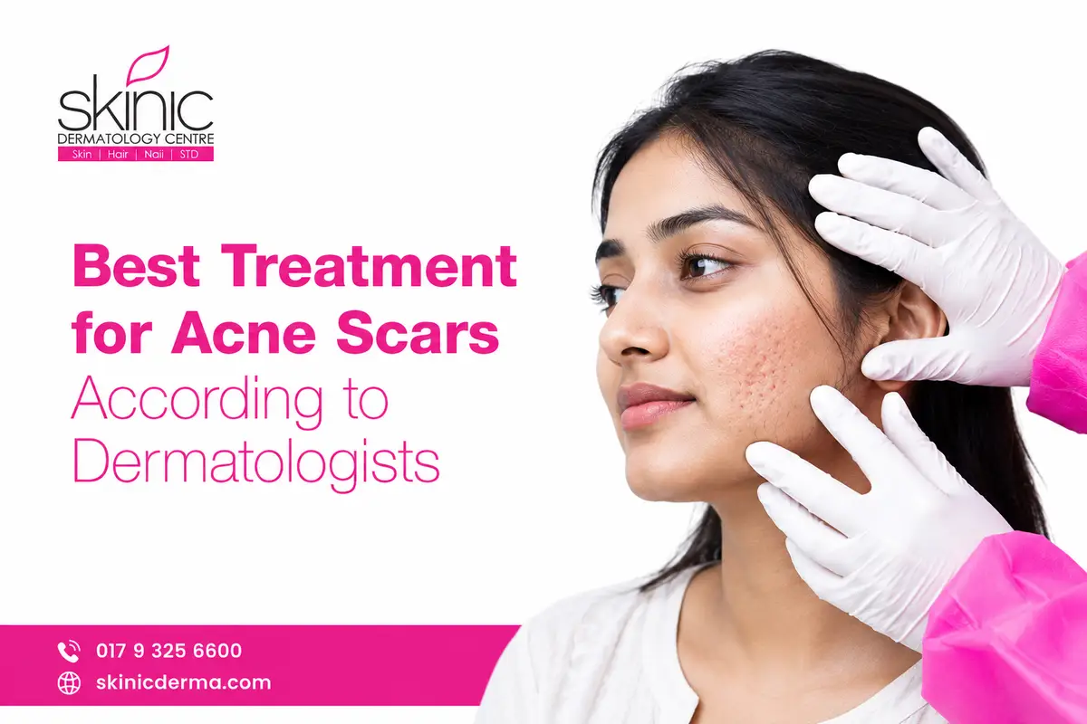 Best-Treatment-for-Acne-Scars Best Treatment for Acne Scars in Dhaka