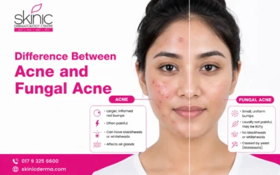 Difference Between Acne and Fungal Acne