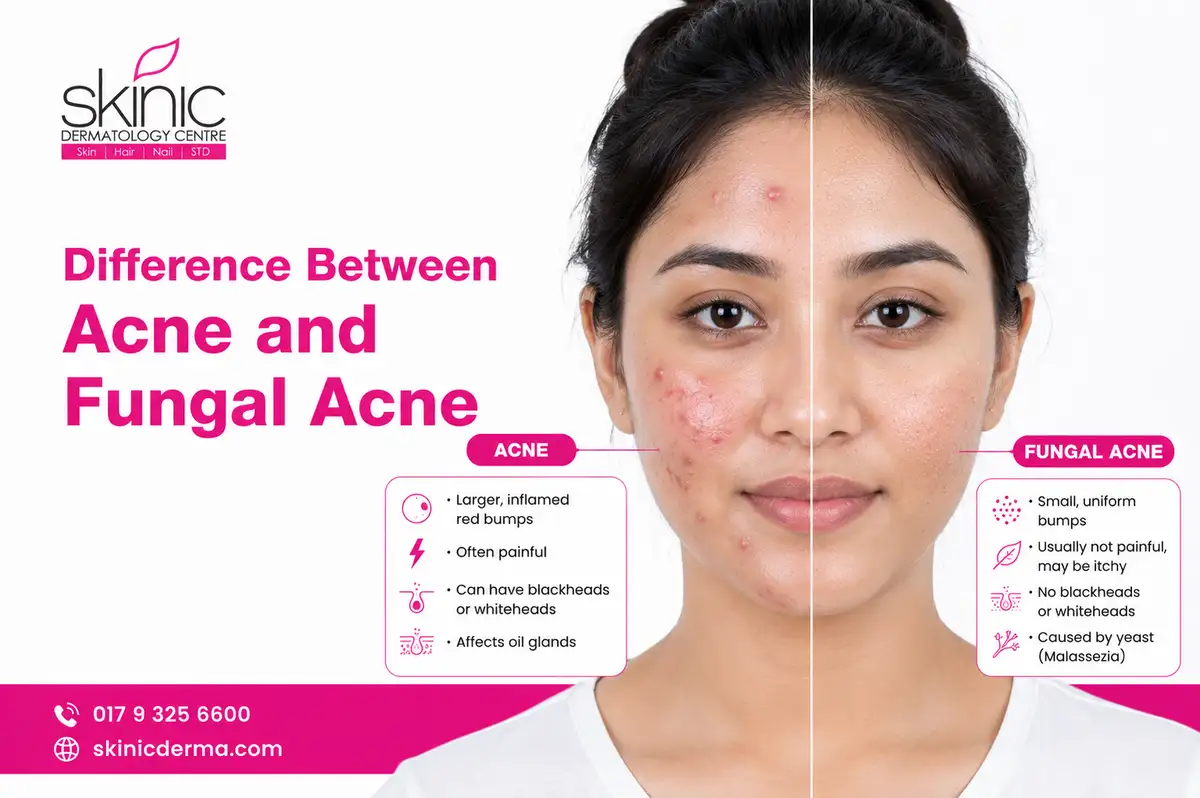 Difference-Between-Acne-and-Fungal-Acne Difference Between Acne and Fungal Acne